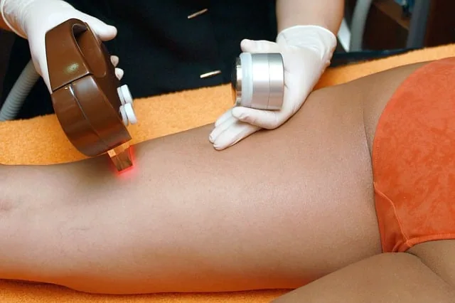 Epilation laser